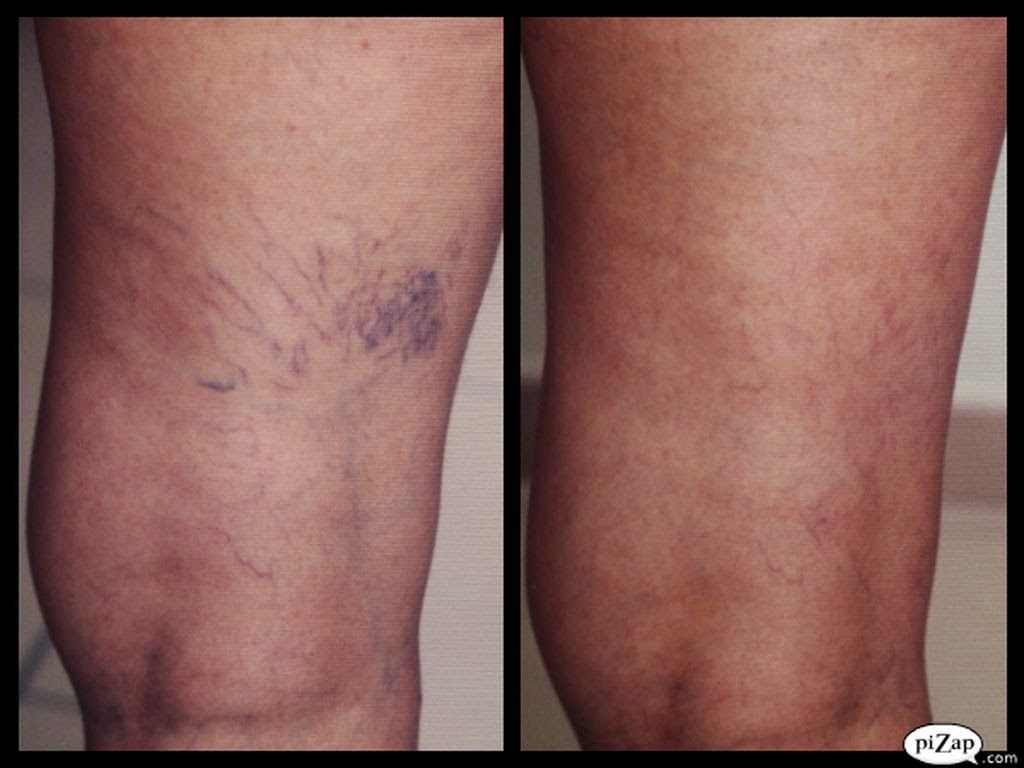 Varices como rapido las quitar